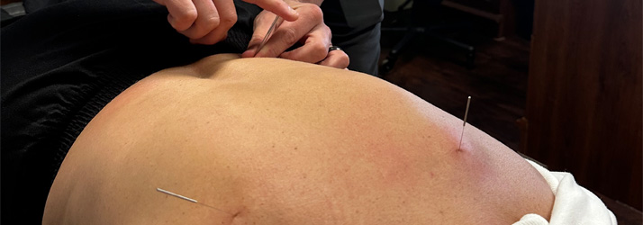 Chiropractic Columbus OH Dry Needling